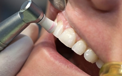 The Difference Between a Deep Teeth Cleaning and a Regular 6 Month Cleaning…