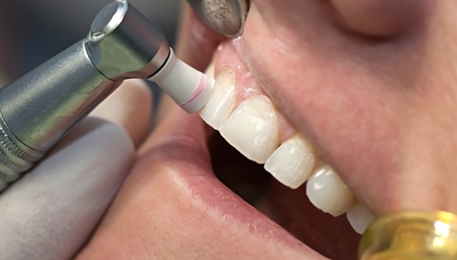 The Difference Between a Deep Teeth Cleaning and a Regular 6 Month Cleaning…