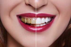 Deep Teeth Cleaning - Do I Really Need It? - Perfect Teeth
