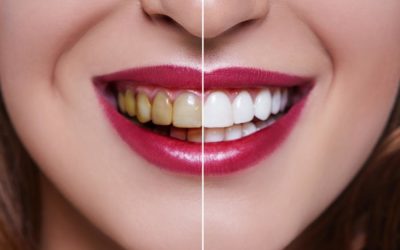 The Benefits of a Deep Cleaning Treatment For Your Teeth and Gums When You Haven’t Been Regularly Going To the Dentist…