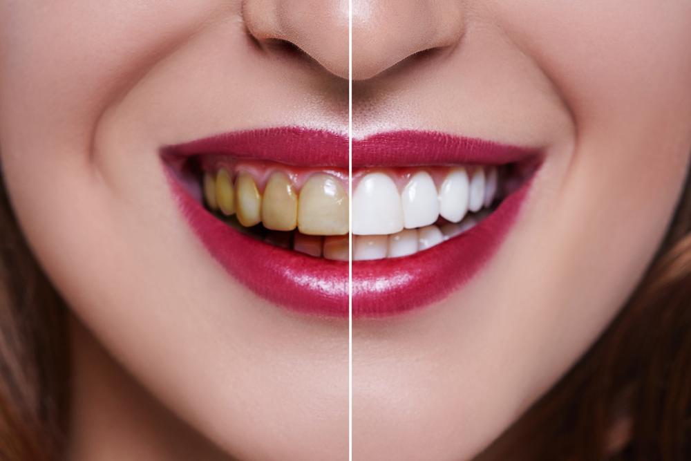 the-benefits-of-a-deep-cleaning-treatment-for-your-teeth-and-gums-when