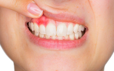 What an Abscessed Tooth Is, The Types, and How To Treat The Infection…