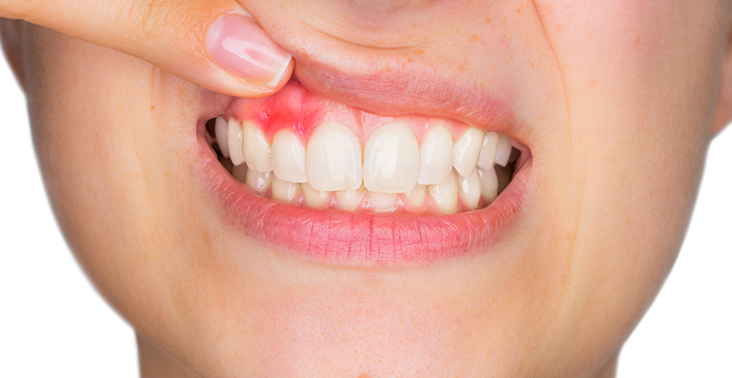 what-an-abscessed-tooth-is-the-types-and-how-to-treat-the-infection