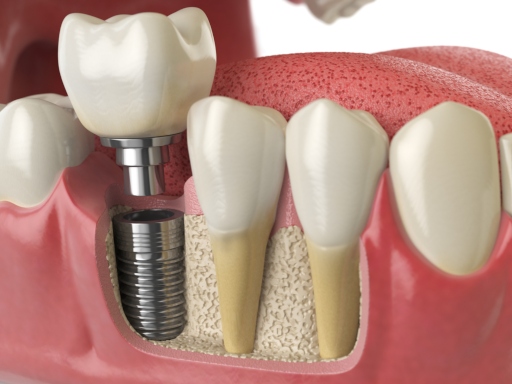 The 5 Main Tooth Replacement Options Most Dentist Will Recommend…