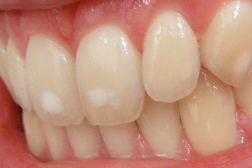 What You Can Do If You Find White Spots On Your Teeth…