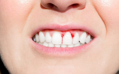 Do You Have Periodontal Disease? Here Are a Few Signs to Look For…