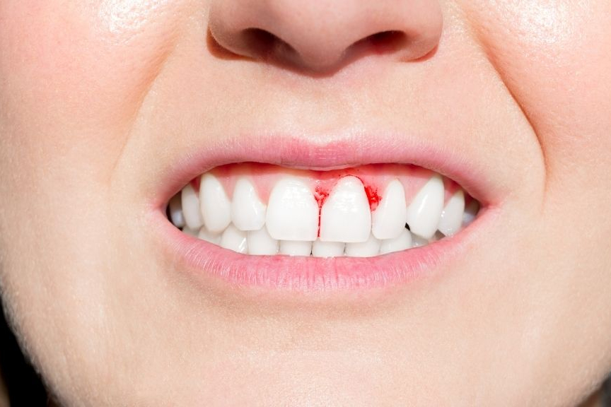 Do You Have Periodontal Disease? Here Are a Few Signs to Look For…