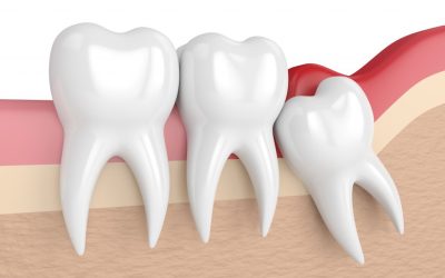 What Are Wisdom Teeth And Do I Need To Have Them Removed?…
