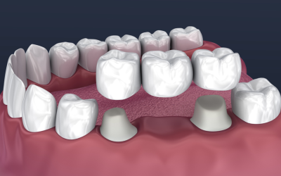 7 Dental Issues Crowns and Bridges Can Fix…