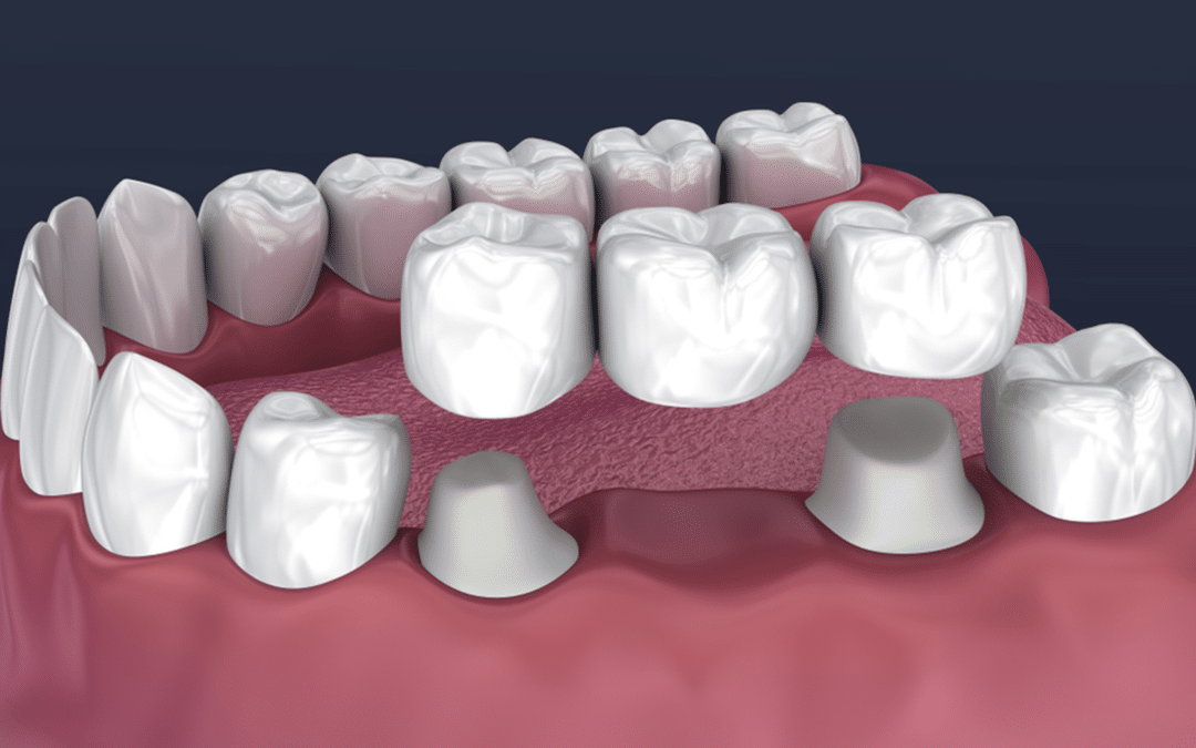 7 Dental Issues Crowns and Bridges Can Fix…