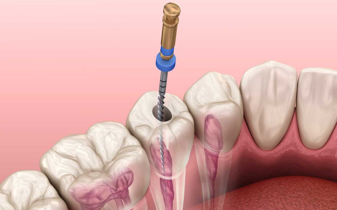 Is a Root Canal Painful? Here is the Truth!…