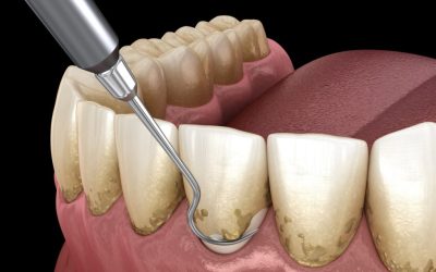 Periodontal Treatment: A Comprehensive Guide to Saving Your Teeth…