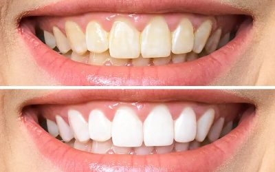 The Benefits of Professional Teeth Whitening: Achieve a Brighter, More Confident Smile…