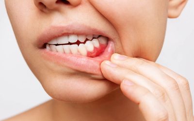 Recognizing the Early Signs of Gum Disease…