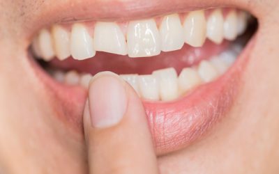5 Options for Treating Chipped or Broken Teeth…
