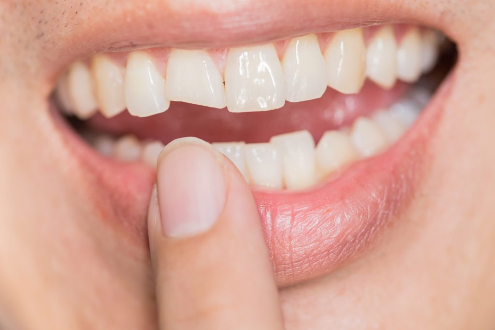 5 Options for Treating Chipped or Broken Teeth…