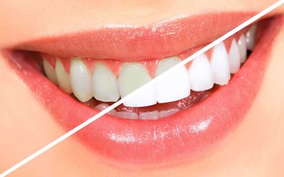 A Guide To Understanding the Various Types of Professional Teeth Whitening…