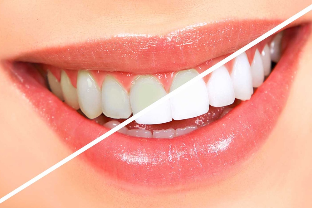 A Guide To Understanding the Various Types of Professional Teeth Whitening…