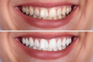 Teeth Whitening Services Dentists Burlington Northern Kentucky | Torbeck Dental