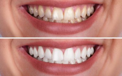 What You Should Know About Professional vs. At-Home Teeth Whitening…