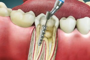 Root Canal Dentist Burlington Kentucky | Torbeck Dental