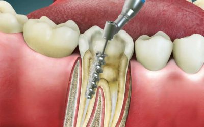 5 Signs You Might Need a Root Canal Treatment – Dental Care in Burlington, Kentucky…