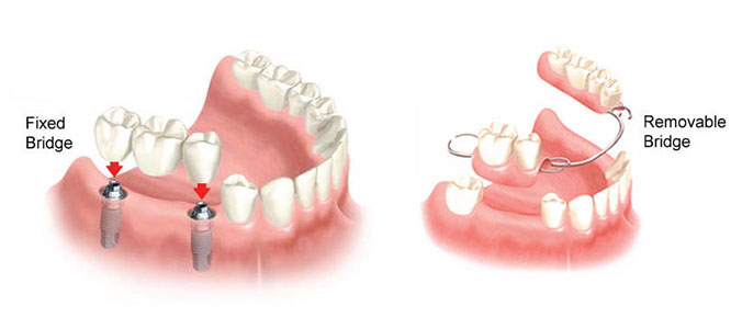 Dental Bridges | Torbeck Dental Illustration showing two dental implants supporting a fixed bridge on the left and a removable bridge attached to implants on the right.