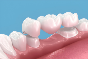 dental Bridges kentucky | Torbeck Dental 3D illustration of an upper dental arch with pink gums and white teeth against a blue background