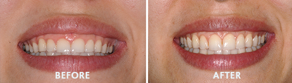 Dental Crown Lengthening | Torbeck Dental Close-up of a smile with a'Before' panel showing yellowish teeth and an 'After' panel showing whiter teeth.
