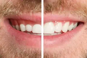 crown-lengtheningjpg | Torbeck Dental Split view of a smile showing teeth before (left) and after (right) whitening treatment. Before are duller; after are whiter and brighter.