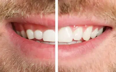 Crown Lengthening: What to Expect Before, During, and After Your Procedure…
