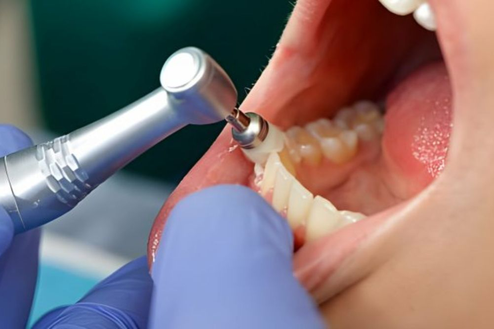 Teeth Cleaning Northern Kentucky | Torbeck Dental Dentist wearing blue gloves drills a patient’s tooth with a handheld dental drill.